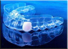 Temporary Bridge - Clear Retainer containing a False Tooth